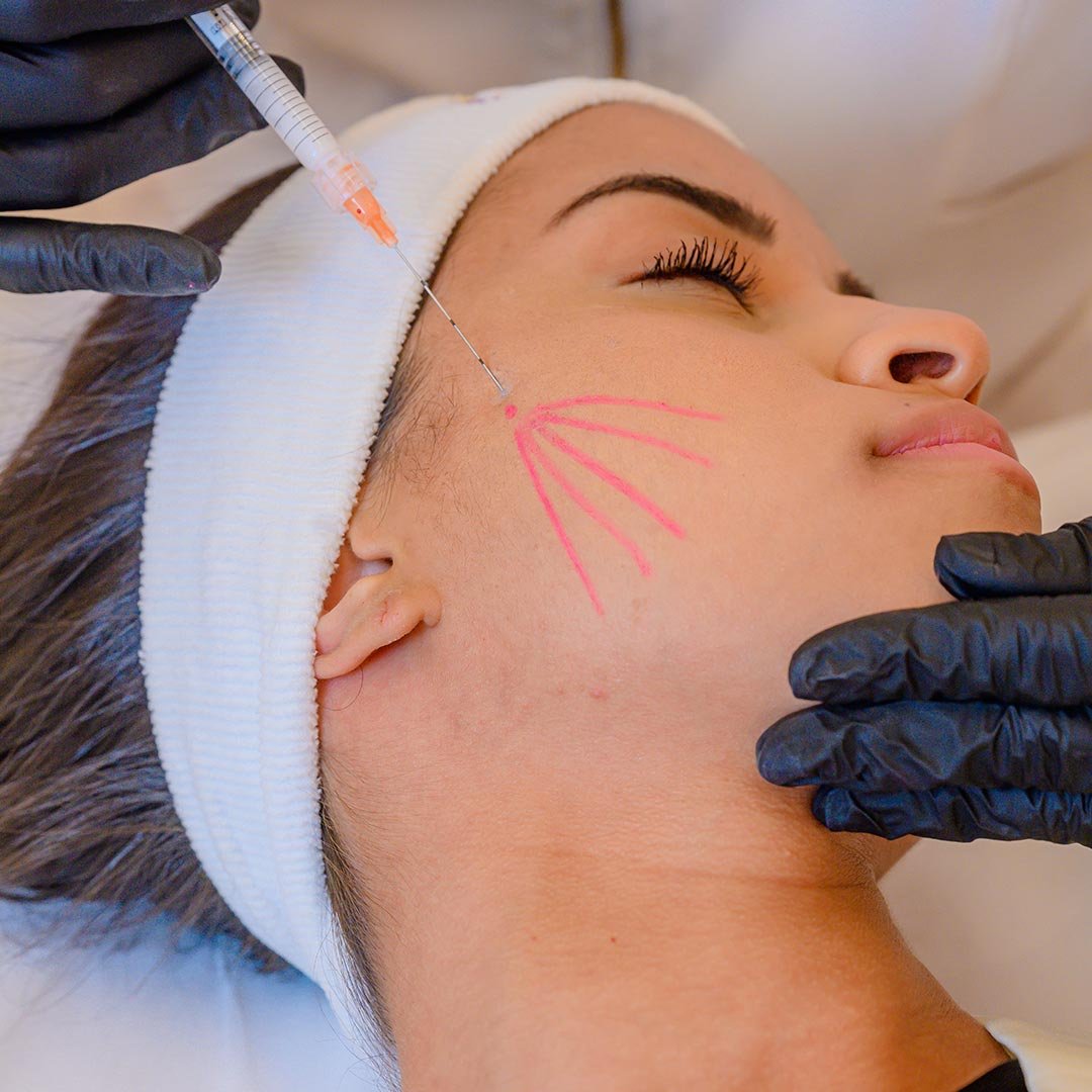 Bioestimulador de Colágeno